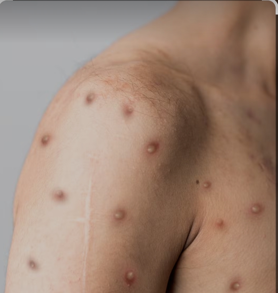 OMS declara Viruela de mono como una emergencia de salud global 