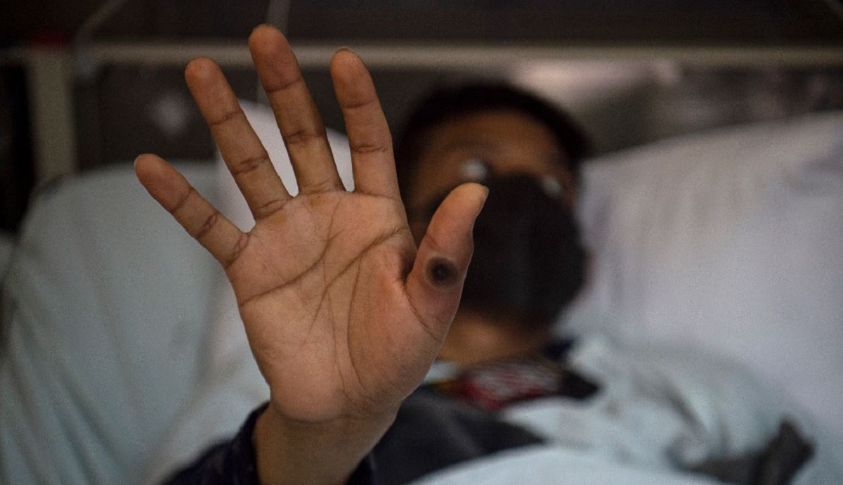 Primer hombre que da positivo a Viruela de Mono, Covid-19 y VIH