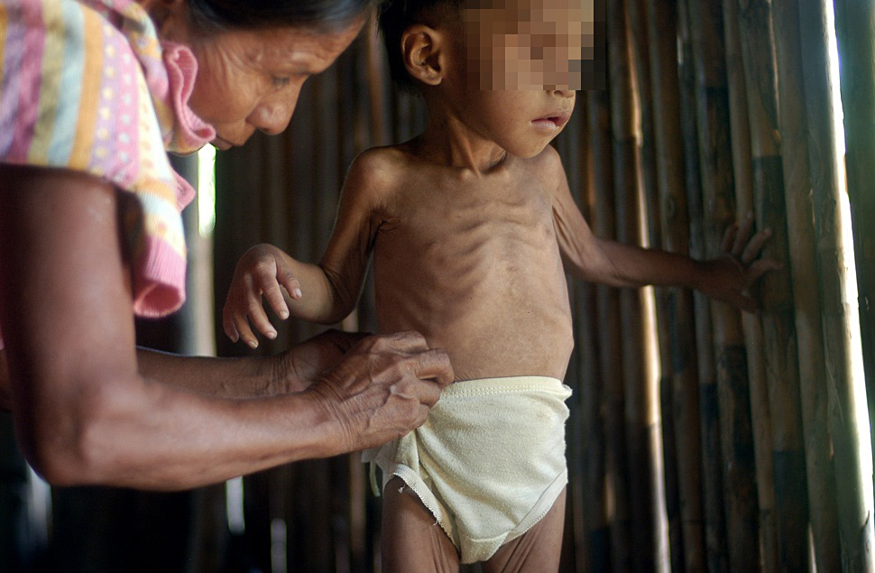 Guatemala registra 8 muertos por desnutrición infantil
