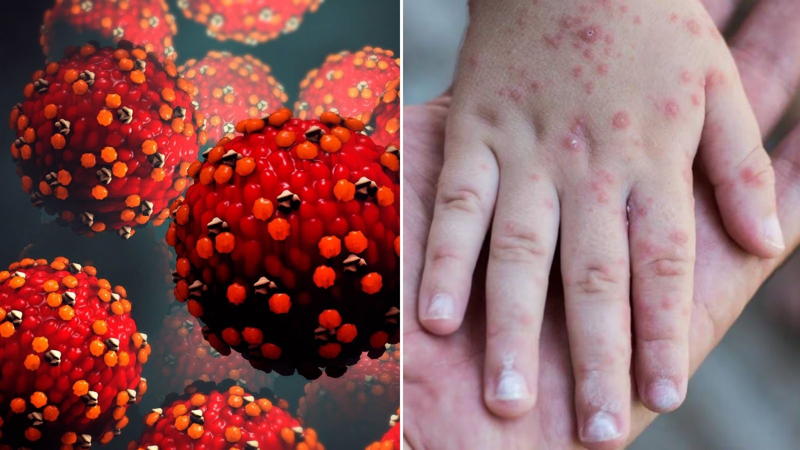 México emite alerta epidemiológica por repunte de sarampión