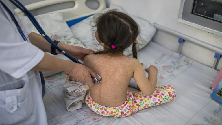 Reportan más de 7 mil casos de Sarampión en las Américas